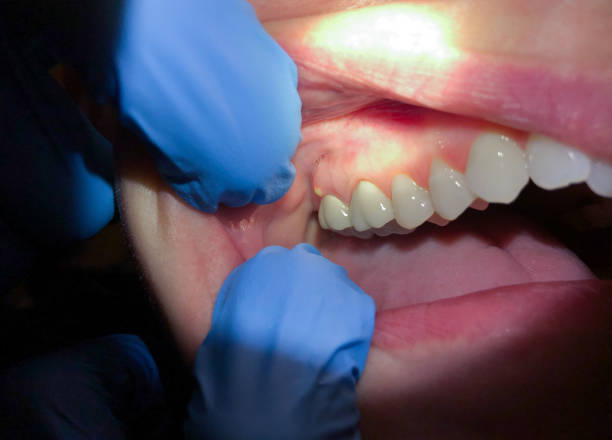 Best Emergency Tooth Extraction in Wilburton, OK
