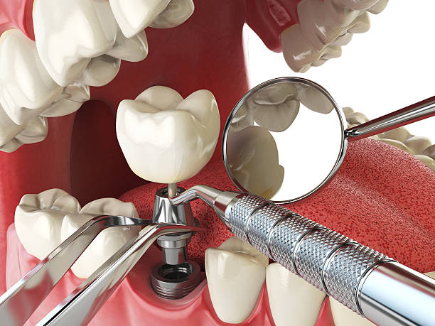 Best Emergency Tooth Extraction in Wilburton, OK
